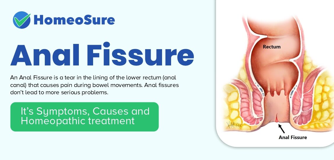  Anal Fissure Treatment