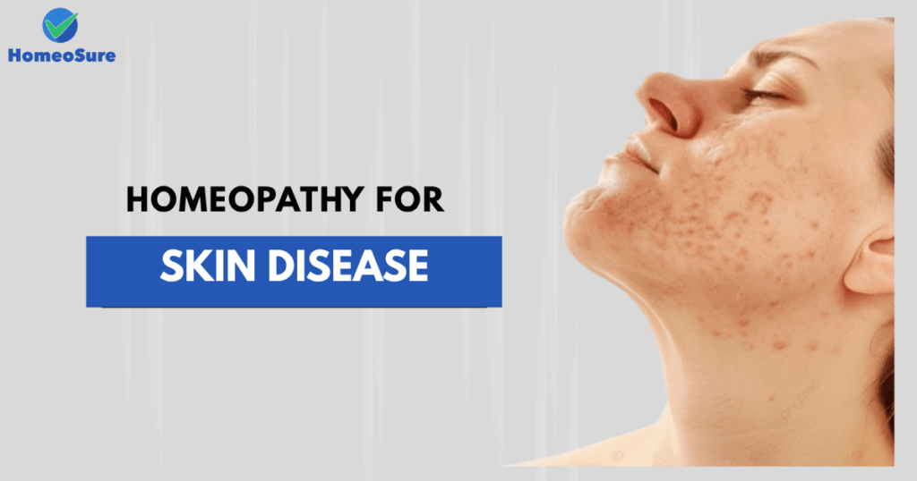 How Can Homeopathy Help with Skin Diseases?